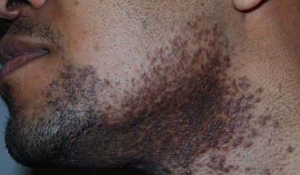 Steroid cream acne cyst
