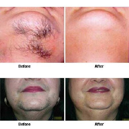 How to get rid of chin hair permanently