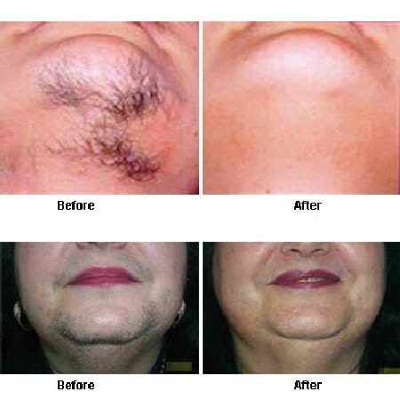 Permanant Facial Hair Removal 68