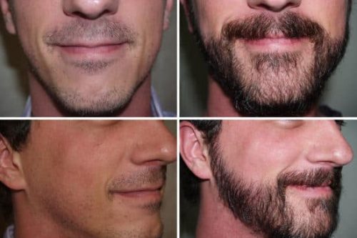 Beard Transplant – Are They Really Worth The Cost?