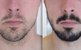 3 months after taking rogain for beard growth