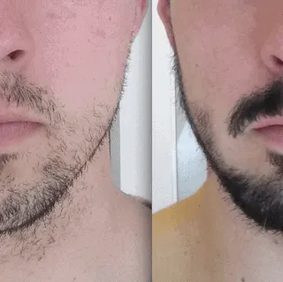 3 months after taking rogain for beard growth