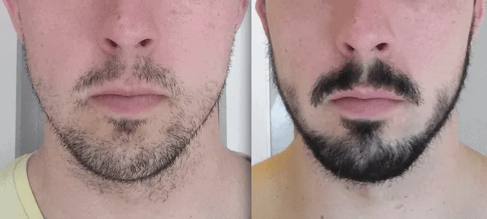 3 months after using minoxidil for beard growth