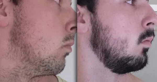 Right Side - After 3 months of using minoxidil for beard