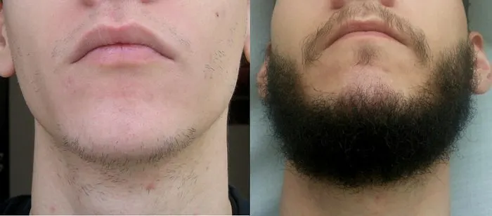 Front Side - Beard before and after photos using Rogaine for 1 year 4 months