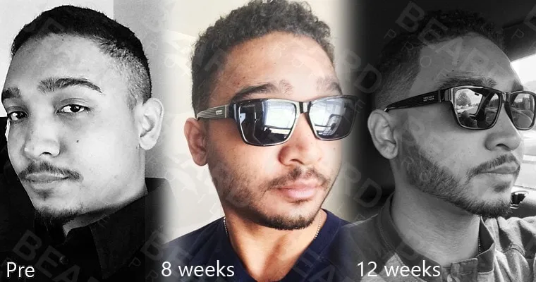 Different phases of beard growth after taking Rogaine