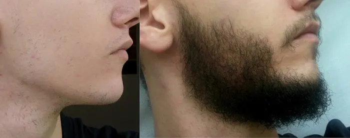 Right side - rogaine beard before and after