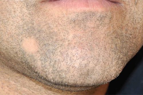 Bald Spot in Beard Under Chin: 4 Easy Fixes