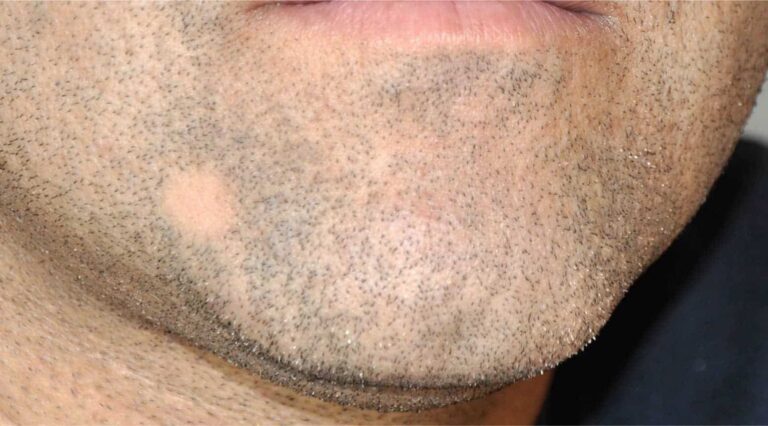 bald spot in beard