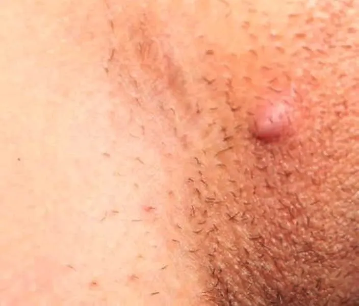 Ingrown Facial Hair