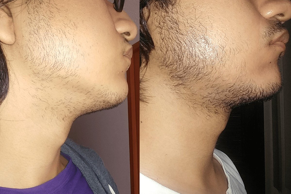 using minoxidil Before and After photos 
