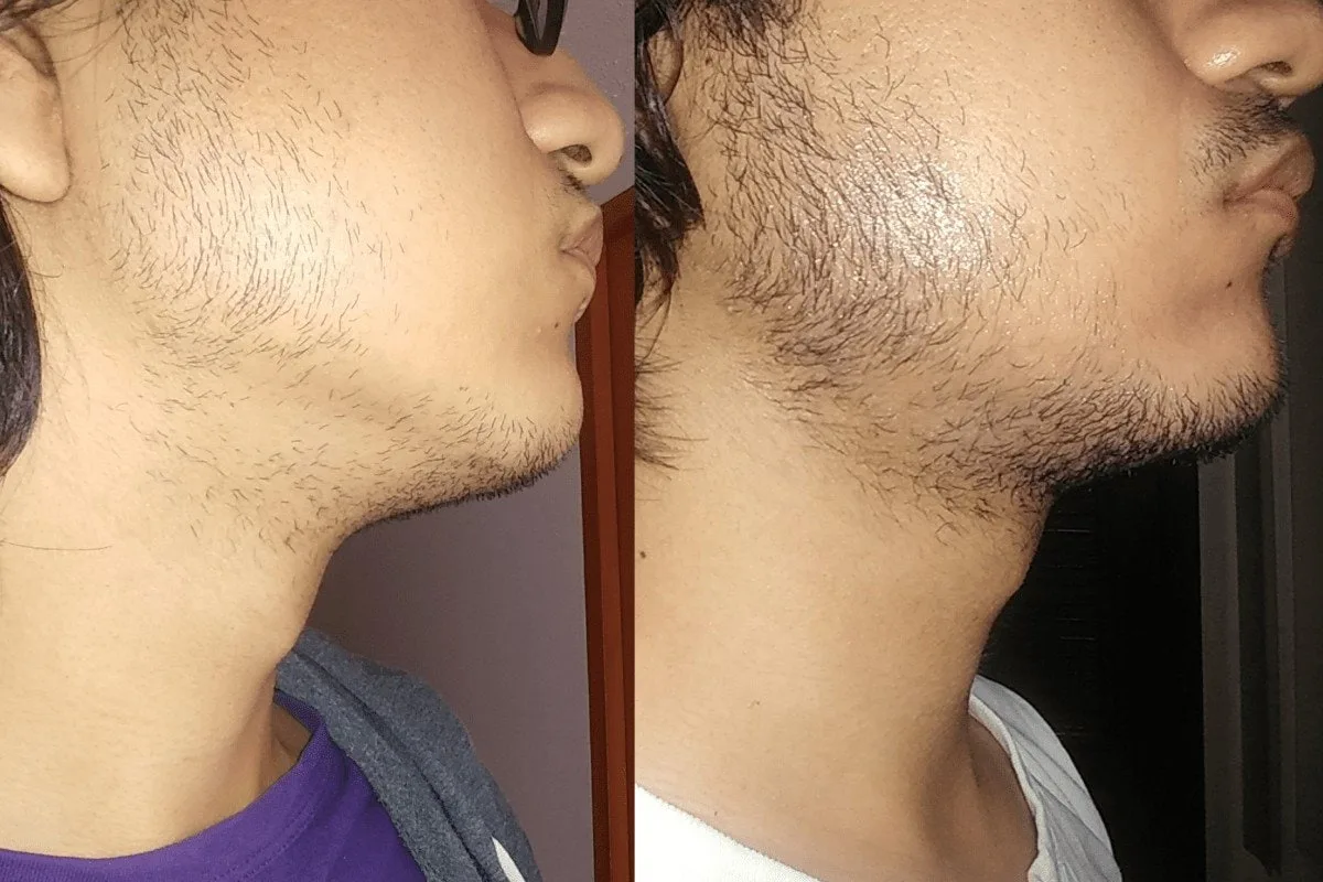 using minoxidil Before and After photos 