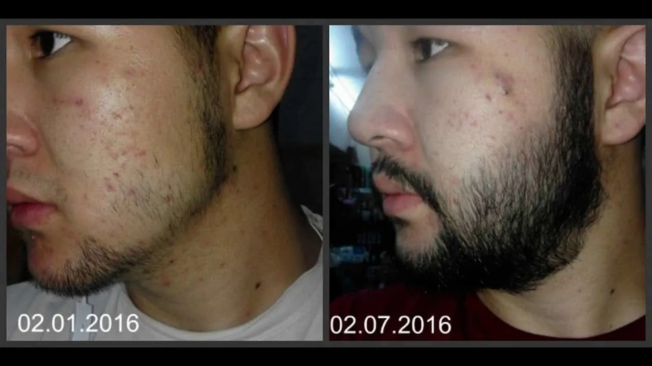 minoxidil beard after 6 month