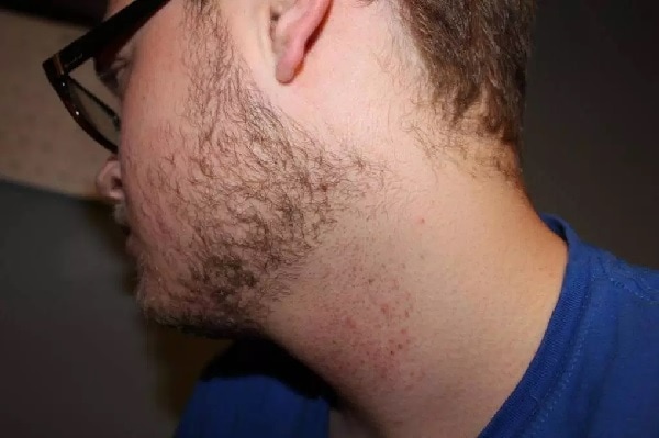 6-steps-to-avoid-neck-irritation-after-shaving-beard-style