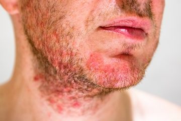 How to Heal Dry, Flaky Skin Under Beard — Beard Style