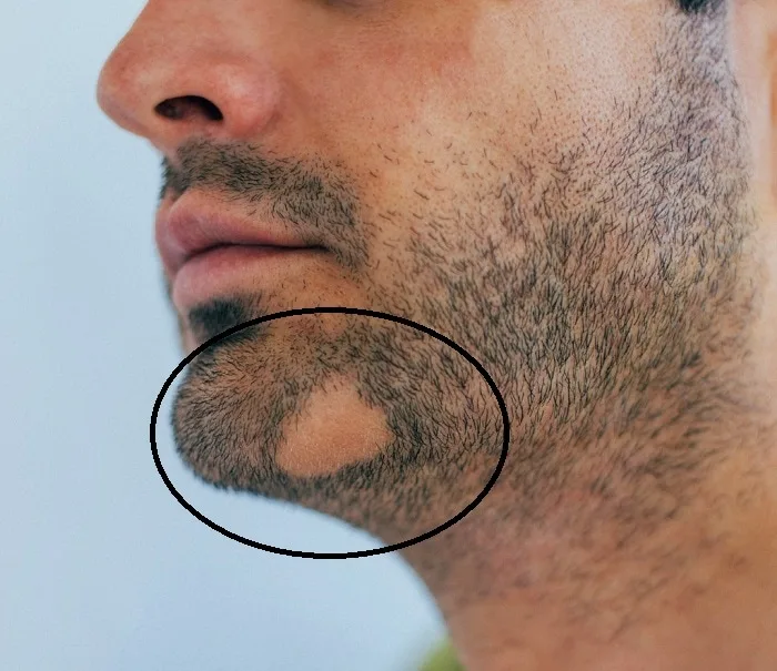 Bald Spot on the chin