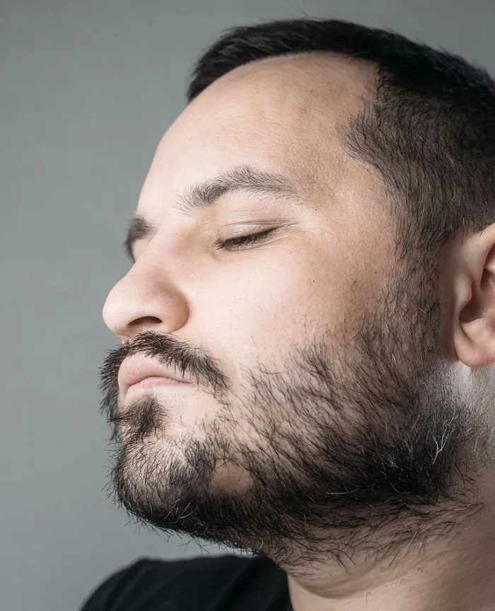 Beard bald spot under chin