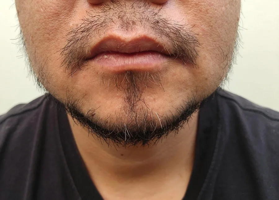 Bald Spot in Mustache